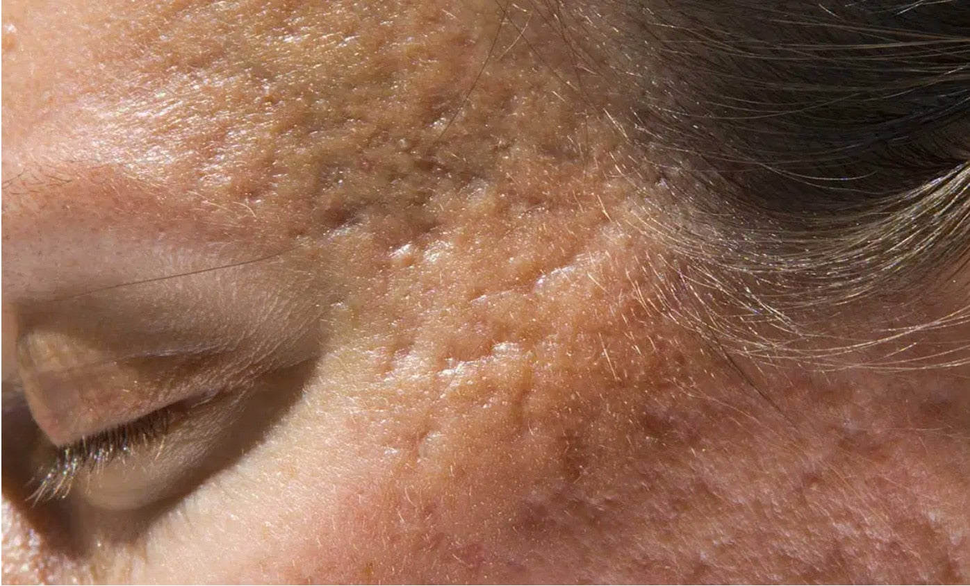 remove acne scarring with marine collagen supplements