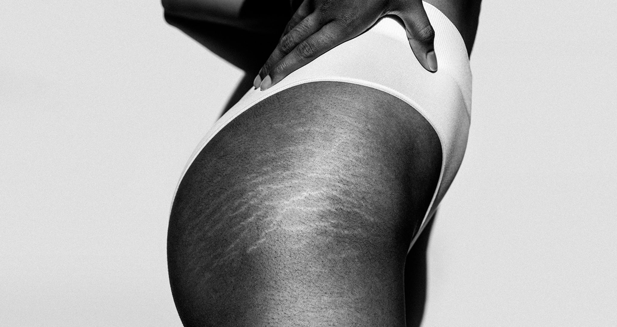 Natural-Remedy-for-Stretch-Marks-1